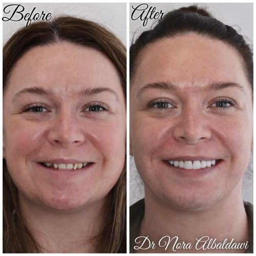 Becky 1, Damon clear braces followed by zoom whitening and composite bonding