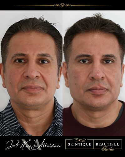 Firas 1, antiwrinkle injections, morpheus 8, hydra facials, co2 laser and fillers in nose, jawline, chin, cheeks