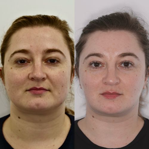 Liz, antiwrinkle injections for grinding and jaw slimming