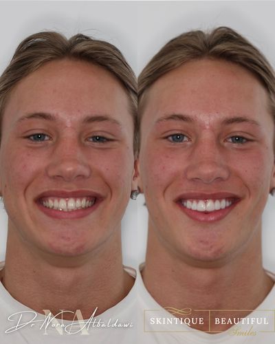 Marko 1, composite bonding