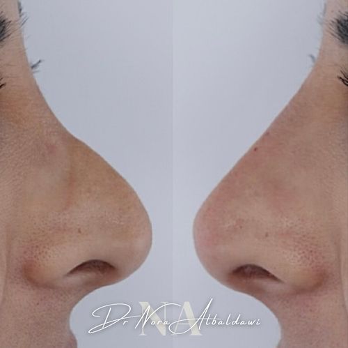 Non surgical rhinoplasty